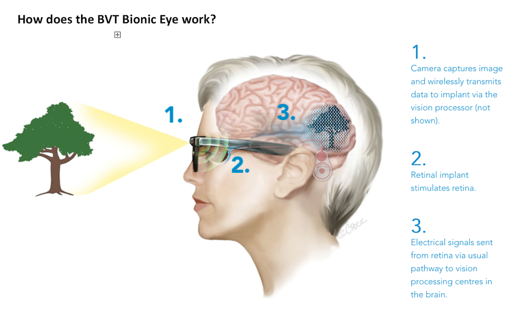 Clinical-Progress-Australia-Bionic-Eye